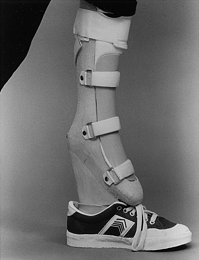 Fig. 21.27, Equinus prosthesis for equalizing leg lengths in a child with a short femur.