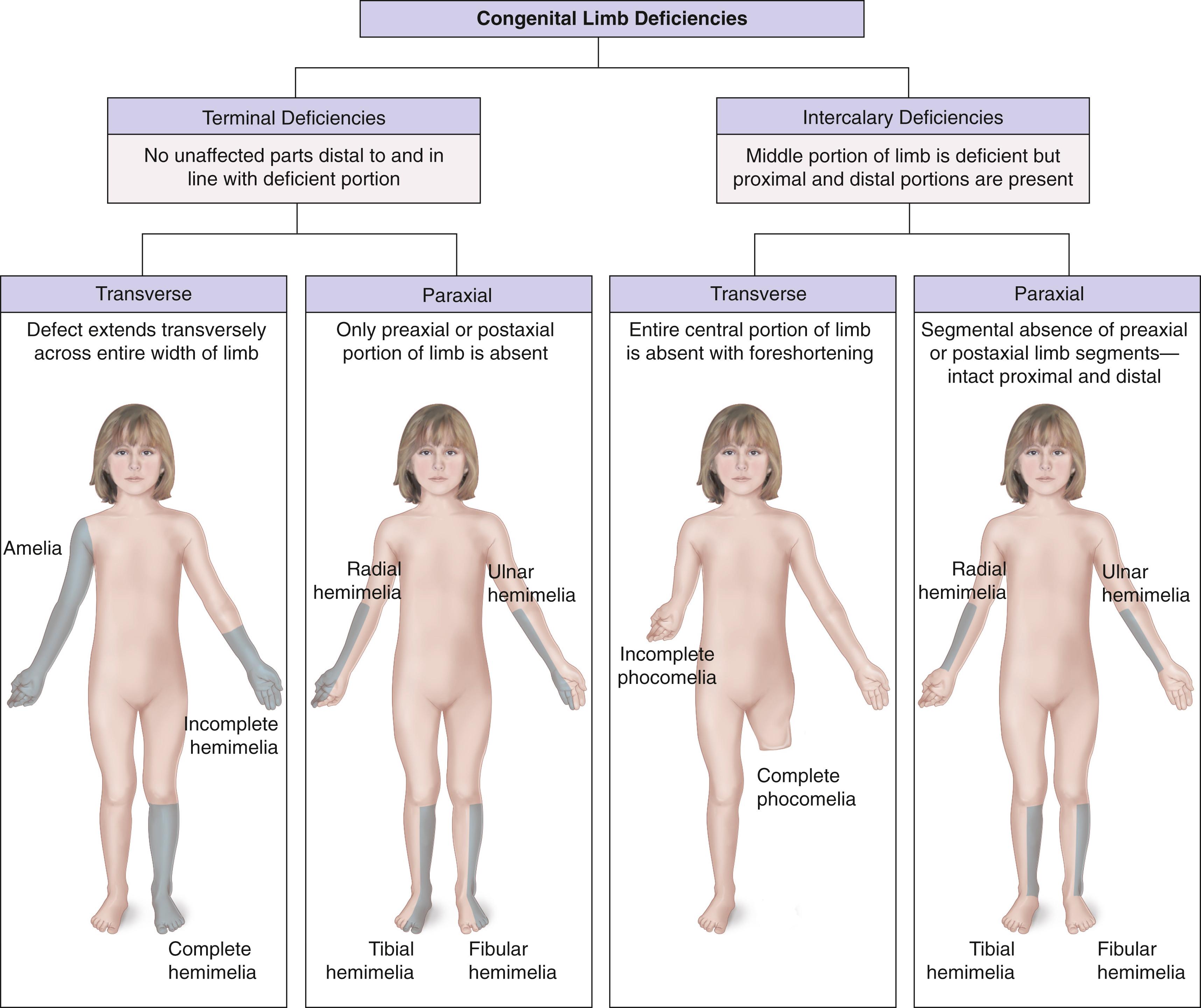 Fig. 21.4, Frantz and O’Rahilly classification of congenital limb deficiencies.