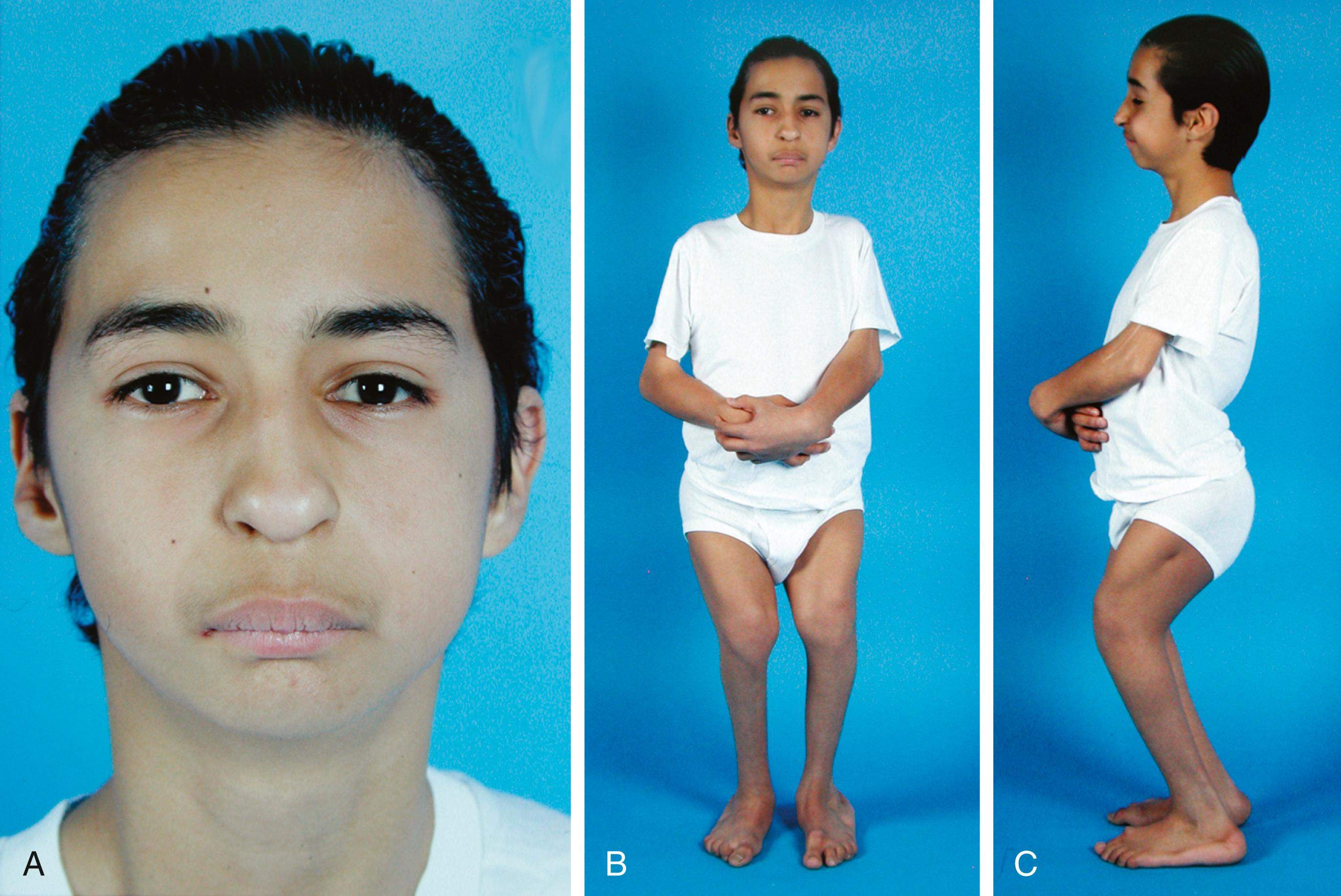 Fig. 21.9, (A–C) Patient with femoral hypoplasia–unusual facies syndrome.