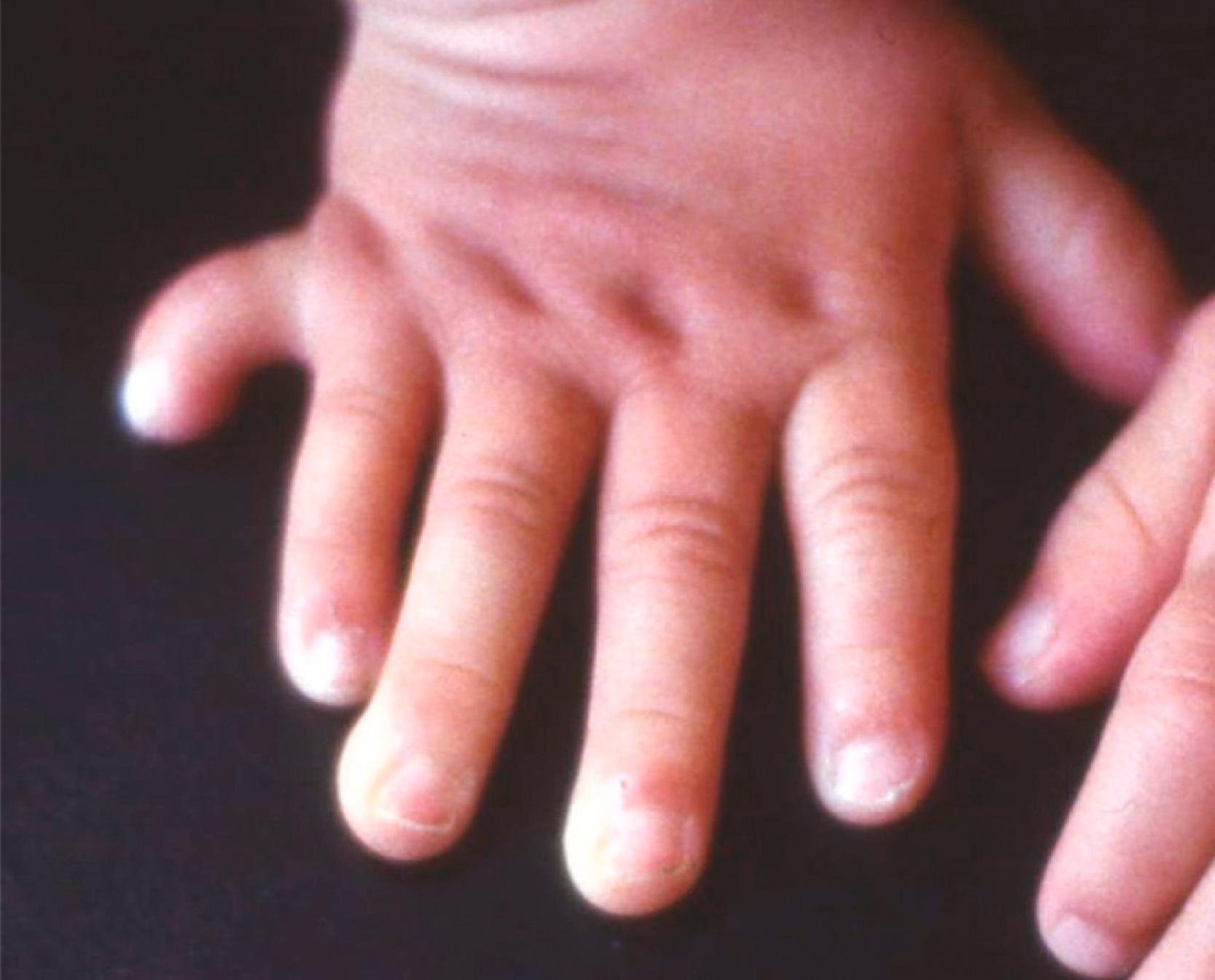 Fig. 10.11, Polydactyly (extra fifth digit) in a patient with Ellis-van Creveld syndrome.