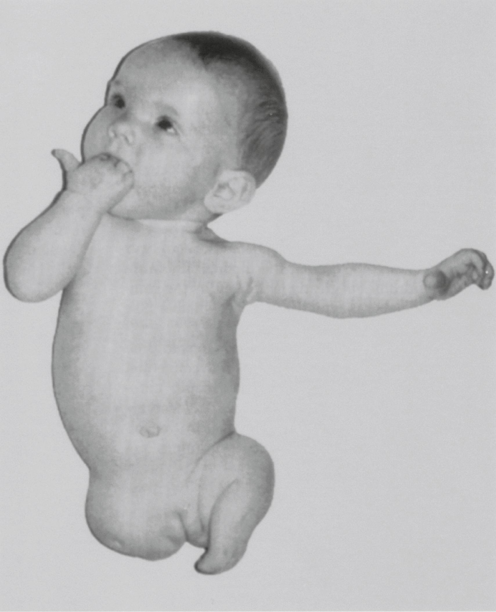 Fig. 10.3, Amelia of the right leg in an infant.