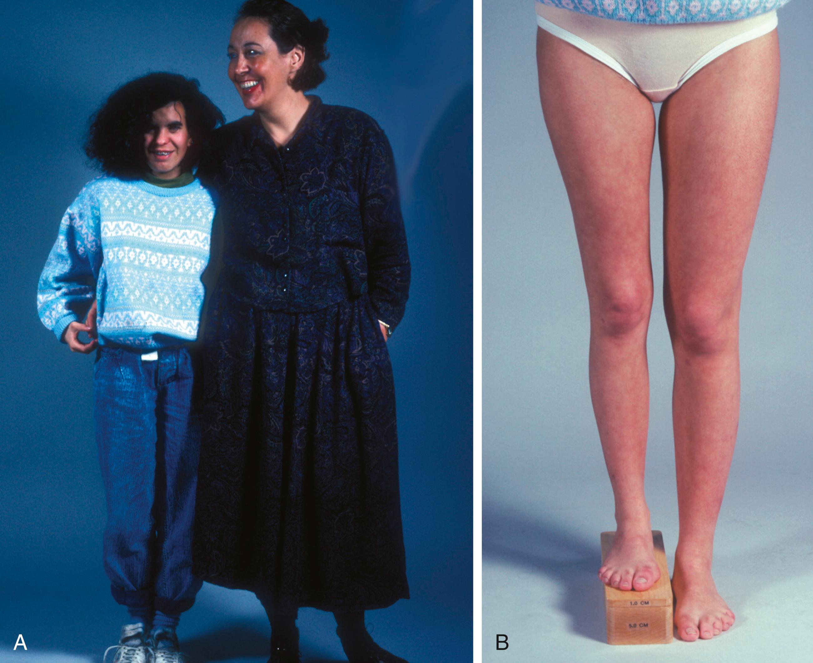 Fig. 20.1, Patient with Russell–Silver syndrome. (A) Patient standing with mother. Note the short stature and right-sided hemiatrophy. (B) Patient standing on 6 cm of blocks to compensate for shortening of the right femur and tibia.