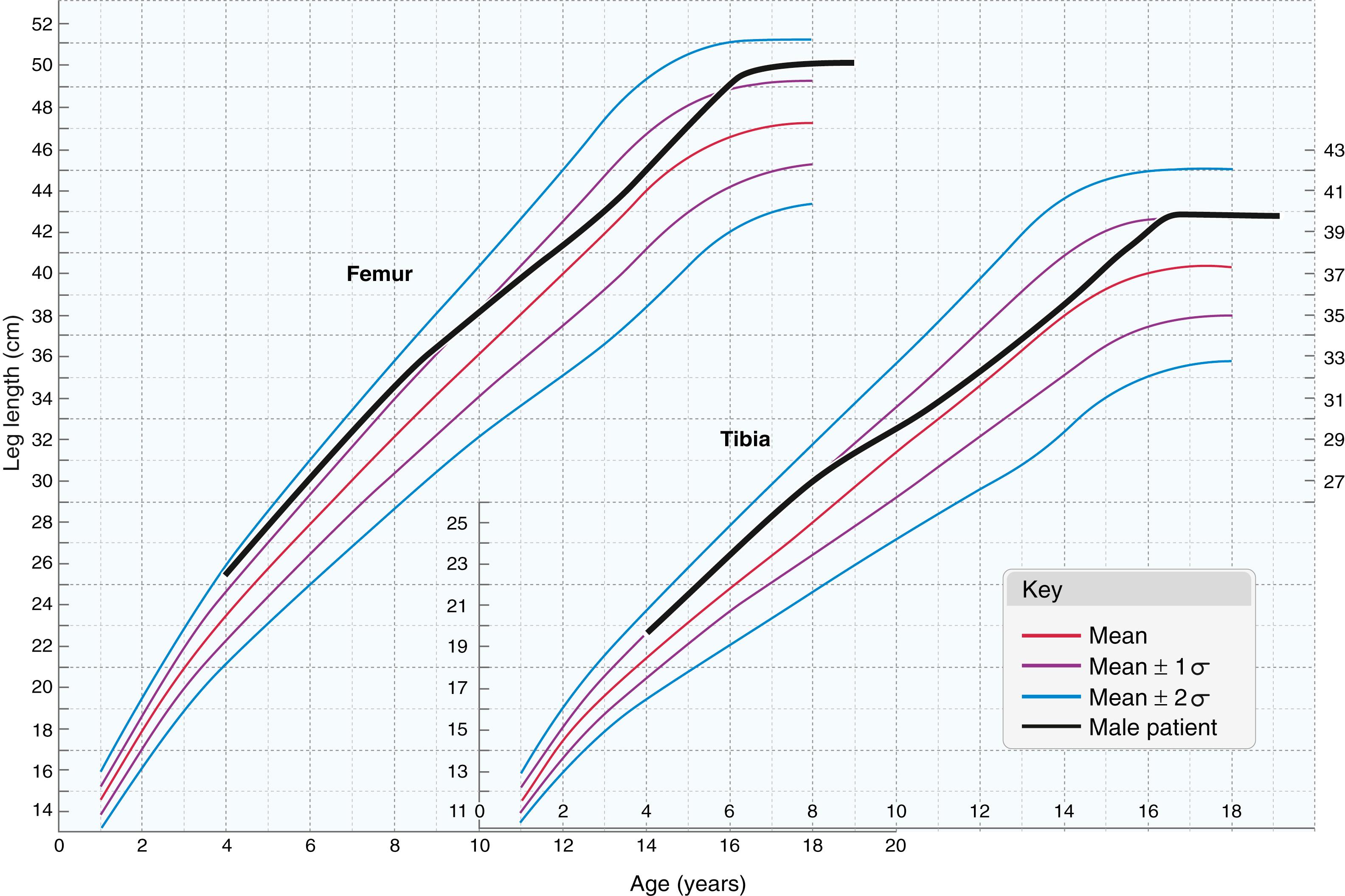 Fig. 20.15, Example of change in percentile length of both femur and tibia (including epiphyses) of a patient followed for hemihypertrophy by Anderson and colleagues. As they noted, if only one examination had been performed when the patient was an adolescent, there would have been a false impression of 50th percentile length, resulting in an underestimation of the ultimate discrepancy. This example points to the need for and value of longitudinal follow-up to gain an overall impression of the maturation and relative size of each patient.