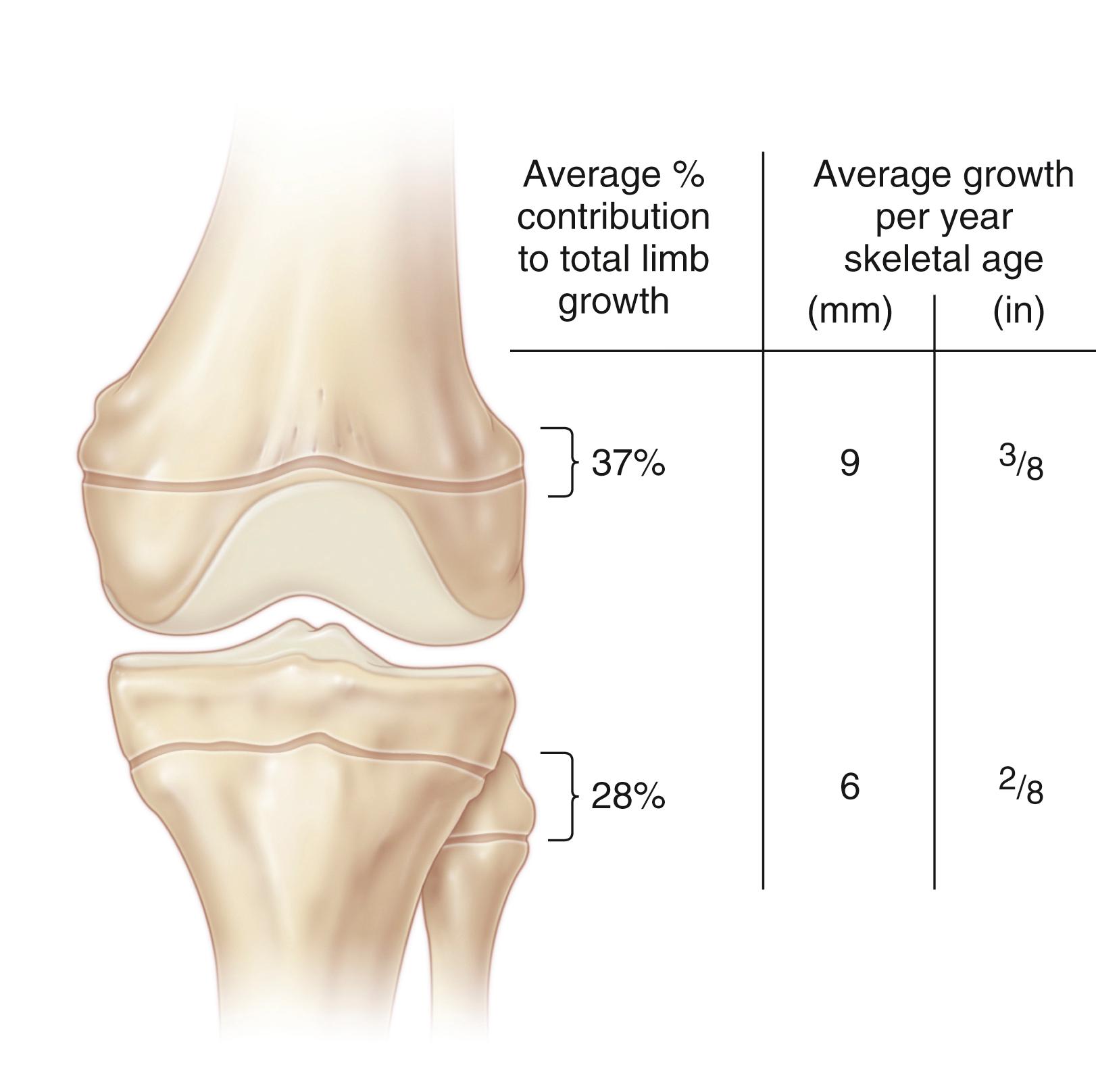 Fig. 20.16, Approximate percentage contribution to total leg length increase and average growth per skeletal year of maturation (in millimeters and inches) of the distal femoral and proximal tibial physes.