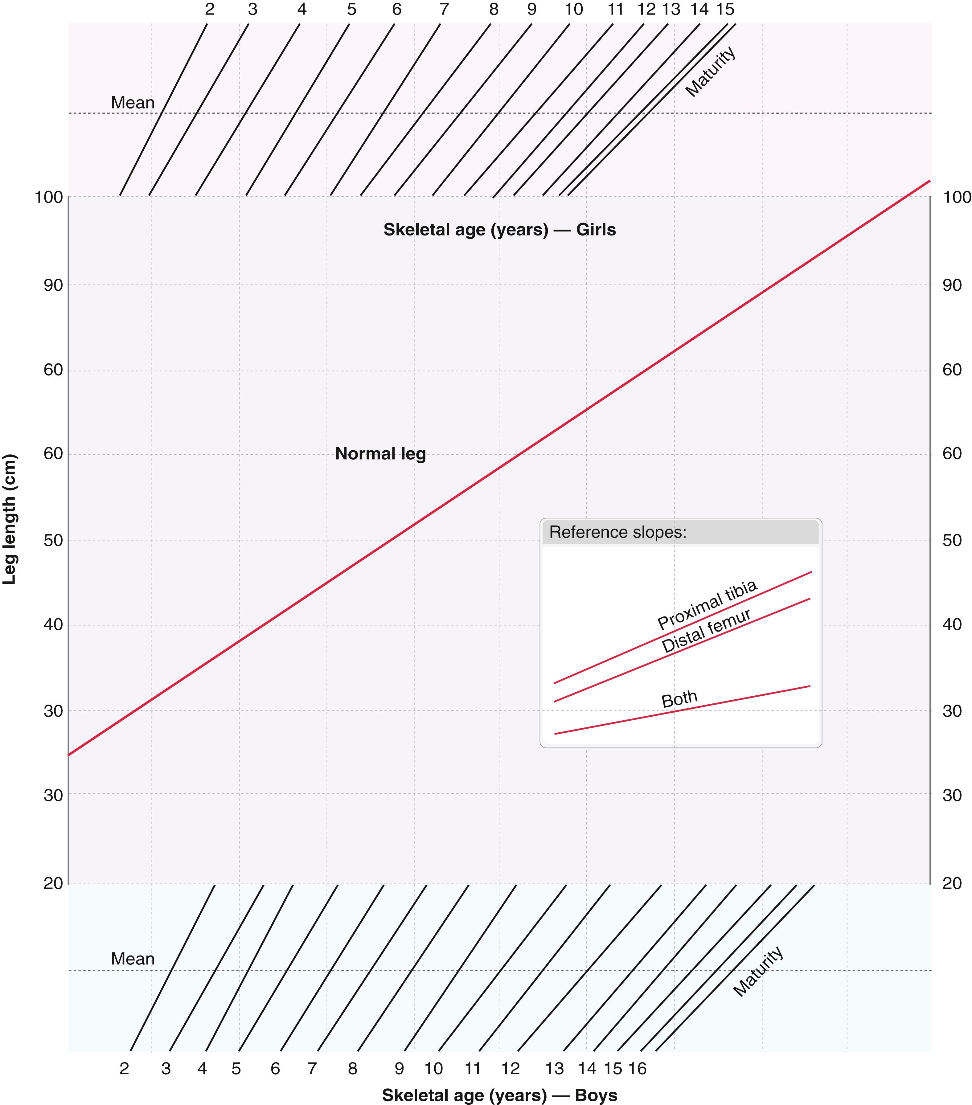 Fig. 20.19, Rotterdam straight-line graph. 45 This modified straight-line graph was based on more modern growth data, and its originators found it to be more accurate in predicting leg length inequality and correction by epiphysiodesis than the Moseley straight-line graph. The method of use is the same as for the Moseley graph (see text, Fig. 20.18 , and Plate 20.1 on page 861 for details).