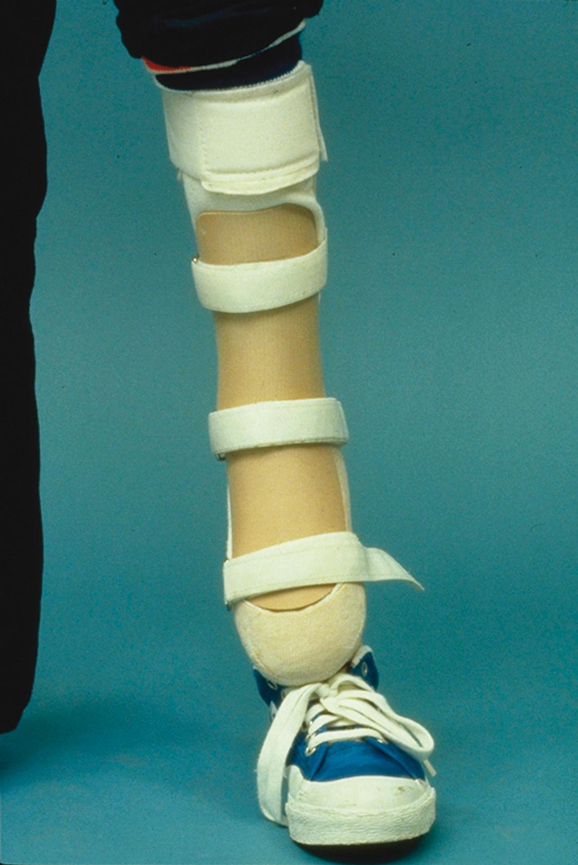 Fig. 20.21, Once a child begins to toe-walk, walk with grossly exaggerated contralateral knee flexion, or hop, an extension orthosis should be considered. An ankle-foot orthosis (usually with an anterior shell) or a knee-ankle-foot orthosis is connected by a shank to a prosthetic foot (e.g., a solid ankle-cushioned heel prosthesis).