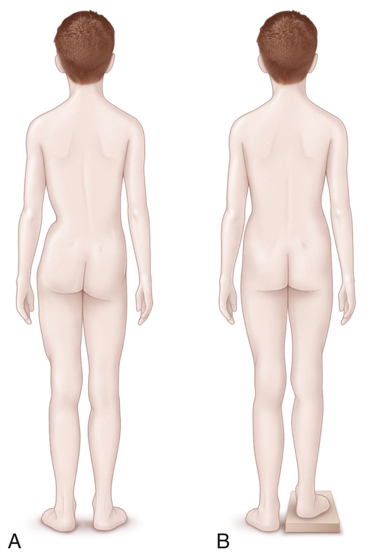 Fig. 20.3, Clinical assessment of limb length inequality with the aid of graduated blocks. (A) True leg length inequality (or fixed functional discrepancy) results in asymmetric iliac crest or posterior iliac spine heights with the patient standing erect. The examiner must be sure that the patient is standing evenly on the legs, with the knees straight and the feet flat on the floor. (B) A reasonably accurate estimation of leg length inequality can be made by having the patient stand erect on sufficient graduated blocks under the shorter limb to level the pelvis.