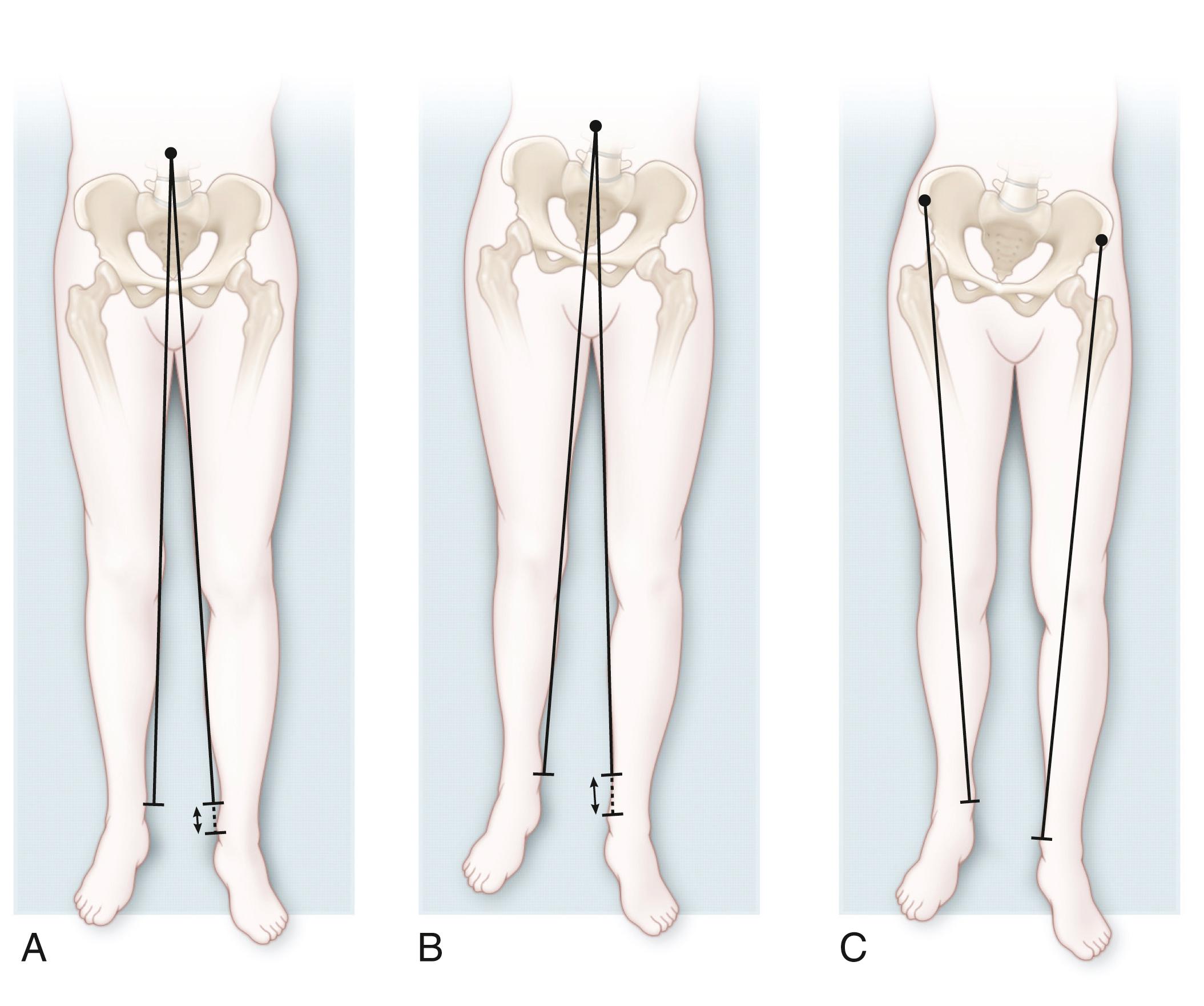 Fig. 20.4, Assessment of functional and actual leg length inequality on the examining table by using a tape measure. Typically, the legs are measured from the umbilicus to the medial malleolus (functional or apparent discrepancy) and from the anterior superior iliac spine to the medial malleolus (actual, true, or structural discrepancy). (A) With the legs in an extended and neutral position, their lengths are unequal when measured both from the umbilicus to the medial malleolus (left leg longer than right) and from the anterior iliac spine to the medial malleolus in a patient with structural leg length discrepancy. (B) In a patient with fixed pelvic obliquity but no true limb length inequality, asymmetry is noted on the measurement of functional leg inequality (from the umbilicus). In this example, the adducted left leg measures longer than the right. (C) Measurement from the anterior superior iliac spine to the medial malleolus demonstrates no structural leg length inequality in the same patient as in (B).