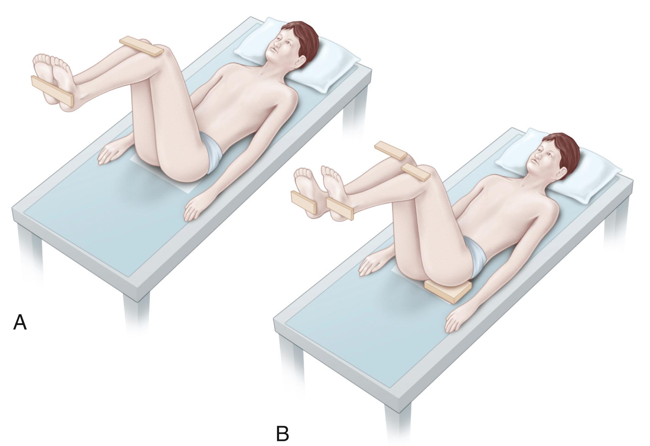 Fig. 20.5, Thigh-leg technique of estimating leg length inequality. (A) The patient is positioned supine on the examination table, with the hips and knees flexed 90 degrees. Discrepancy between the two sides is noted between the table and thigh, between the thighs and knees, and between the soles with the knees even. This drawing shows no discrepancy. (B) An estimation of limb length inequality is made by assessing asymmetry at these three levels.