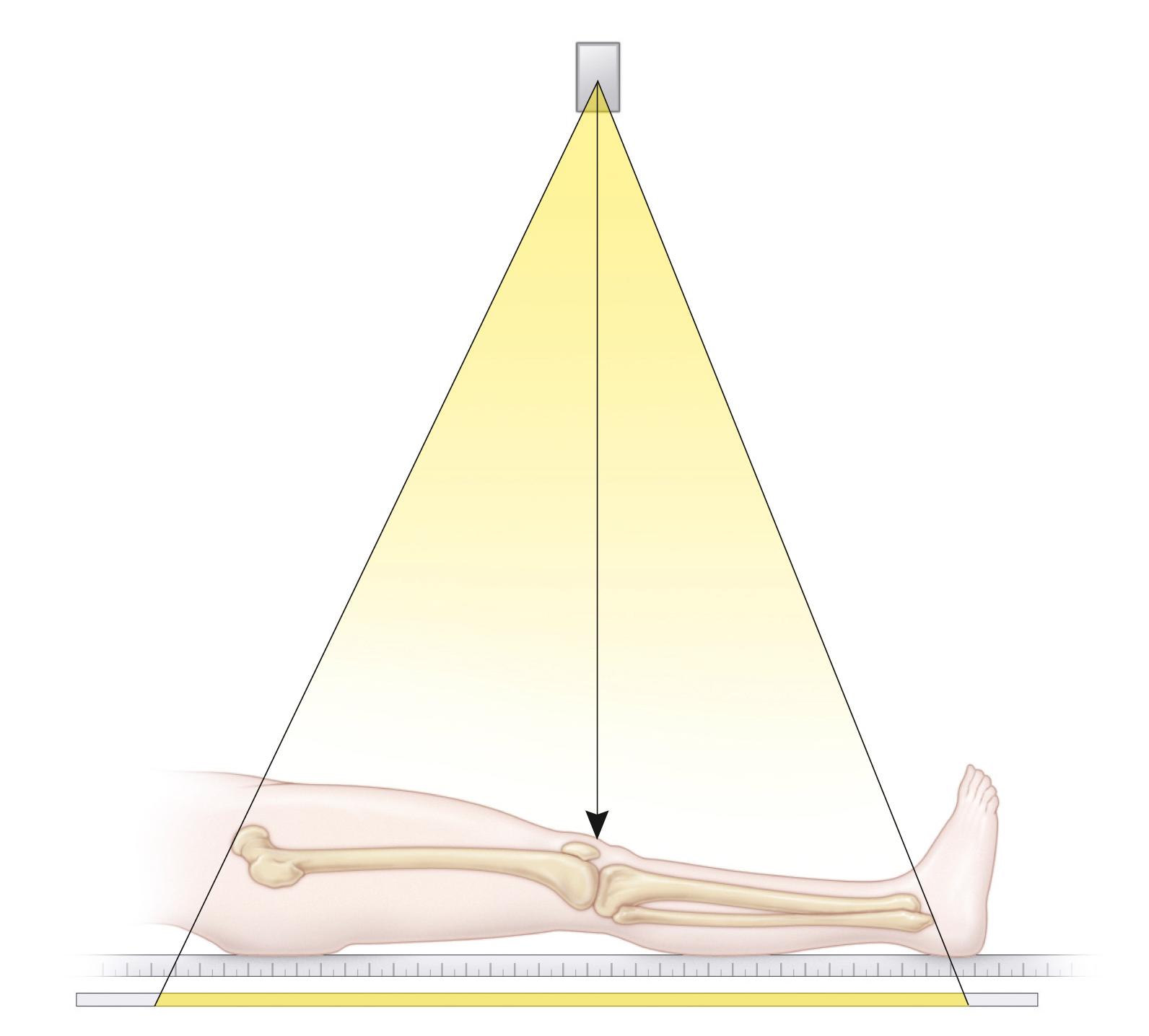 Fig. 20.7, Teleoroentgenography. A long film and a ruler are placed under the patient, and a single exposure is made, centered over the limbs.