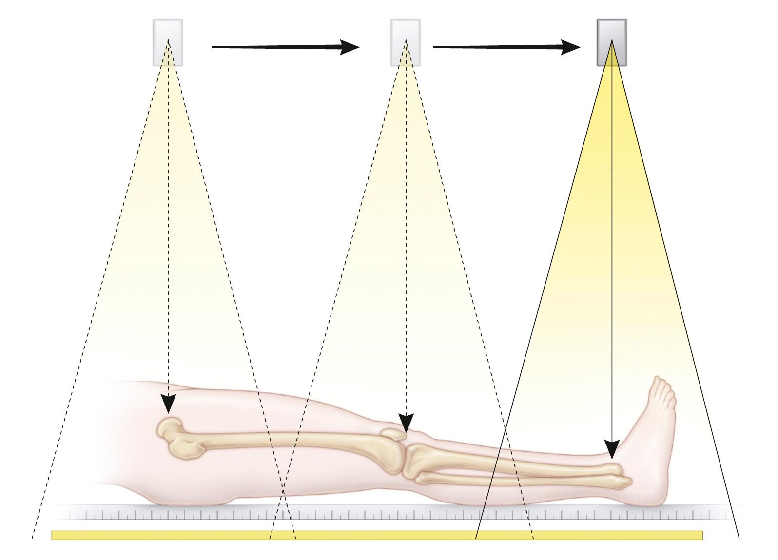 Fig. 20.8, Orthoroentgenography. A long film and a ruler are placed under the patient. Three (or six) exposures are made at the hip, knee, and ankle level, without moving the patient or the film.