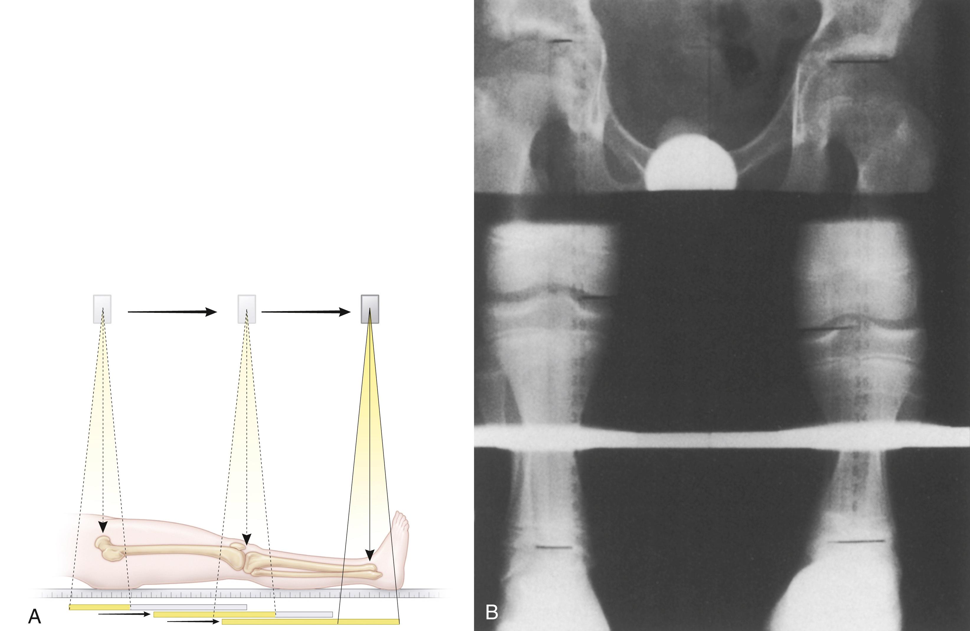 Fig. 20.9, Scanography. (A) A 14- × 17-inch film and a ruler are placed under the patient. Three (or six) exposures are made, centered over the hips, knees, and ankles. The film is advanced under the joint to be radiographed and is exposed sequentially. (B) Scanogram. A smaller film is used than in orthoroentgenography, thus making storage and handling easier. Only a portion of the bone segment is visible on the radiograph.