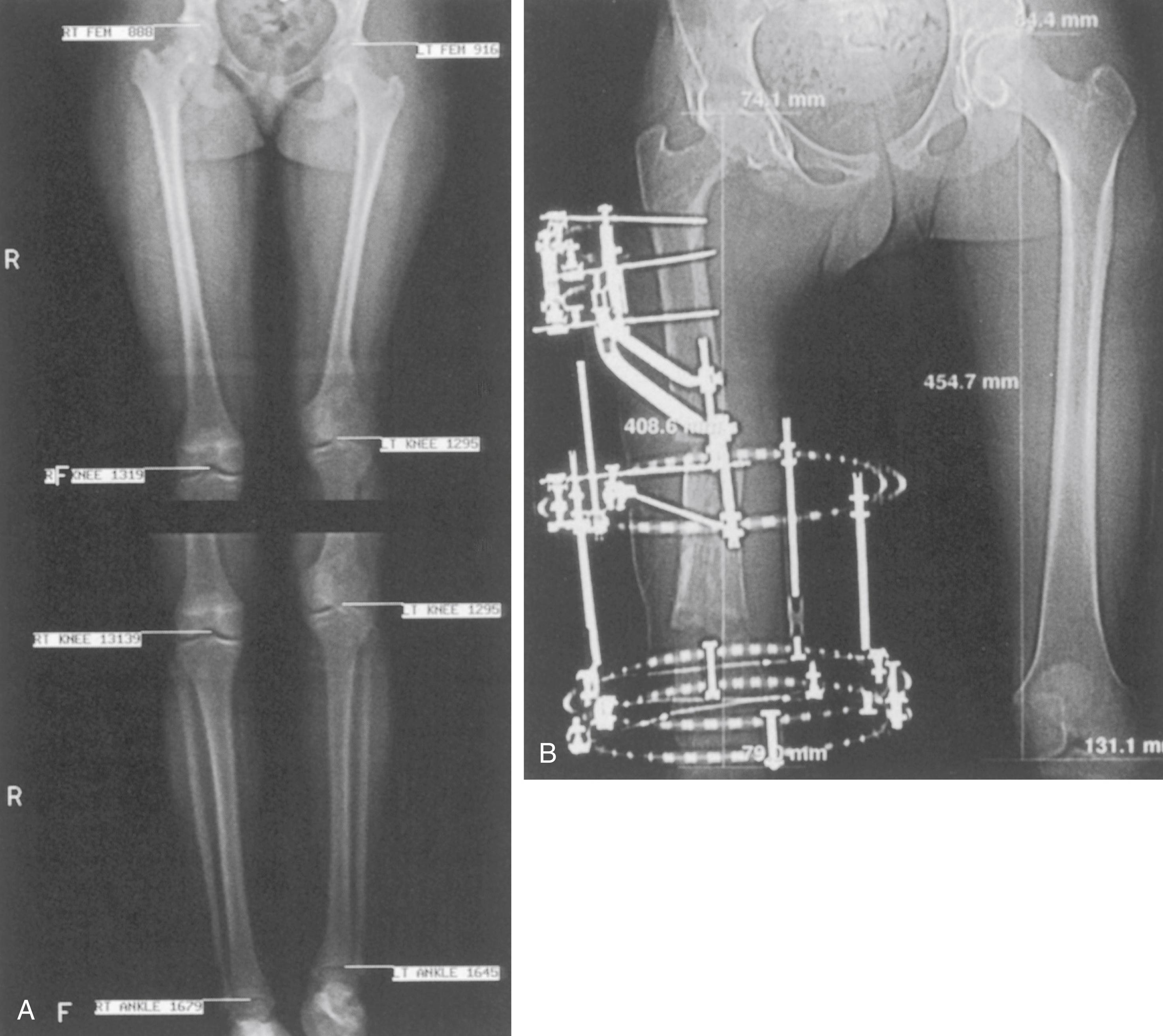 Fig. 20.10, Computed tomography (CT) scanography. (A) CT scanography requires less radiation exposure and less time to acquire, and it is susceptible to fewer magnification, positioning, and movement errors. (B) The technique is particularly useful when positioning is difficult or must be nonstandard, such as when the patient is in a circular external fixator.