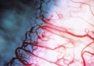 Fig. 15.2, Engorged conjunctival and limbal vessels and possible slight neovascularisation. The anterior limbal loops are clearly visible at the termination of the vessels in the peripheral cornea.