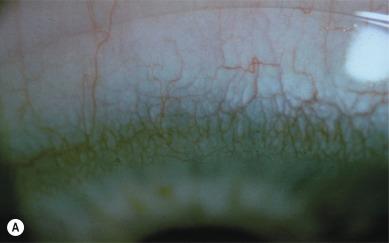 Fig. 15.5, Demonstration of the effect of hypoxia on limbal redness. (A) Grade 2.2 limbal redness is evident in this patient wearing a conventional hydrogel (38% water content hydroxyethyl methacrylate (HEMA)) contact lens in one eye. (B) The same patient is wearing a silicone hydrogel contact lens in the other eye; the extent of limbal redness (grade 1) is much less than that in the eye wearing the HEMA lens.