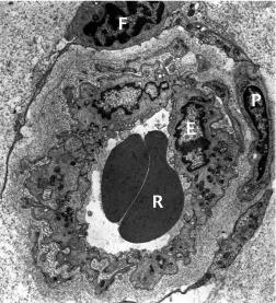 Fig. 15.7, Electron micrograph of a non-fenestrated capillary from the limbal conjunctiva, close to the termination of Bowman’s membrane. R, red blood cells; E, vascular endothelium; F, fibroblast; P, pericyte.
