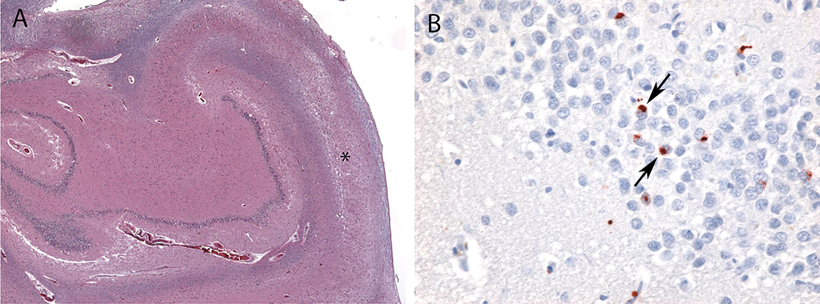 Fig. 6.2, Limbic-predominant age-related TDP-43 encephalopathy (LATE). Hippocampal pathology in LATE typically involves near complete neuronal loss and gliosis within the CA1 subfield without corresponding tau pathology ( A , *hippocampal sclerosis). Hippocampal sclerosis can be focal and is not always observed. An immunostain for phosphorylated TDP-43 shows abnormal cytoplasmic inclusions within the dentate gyrus of the hippocampus ( B , arrows ). Magnification: A , 24×; B , 400×.