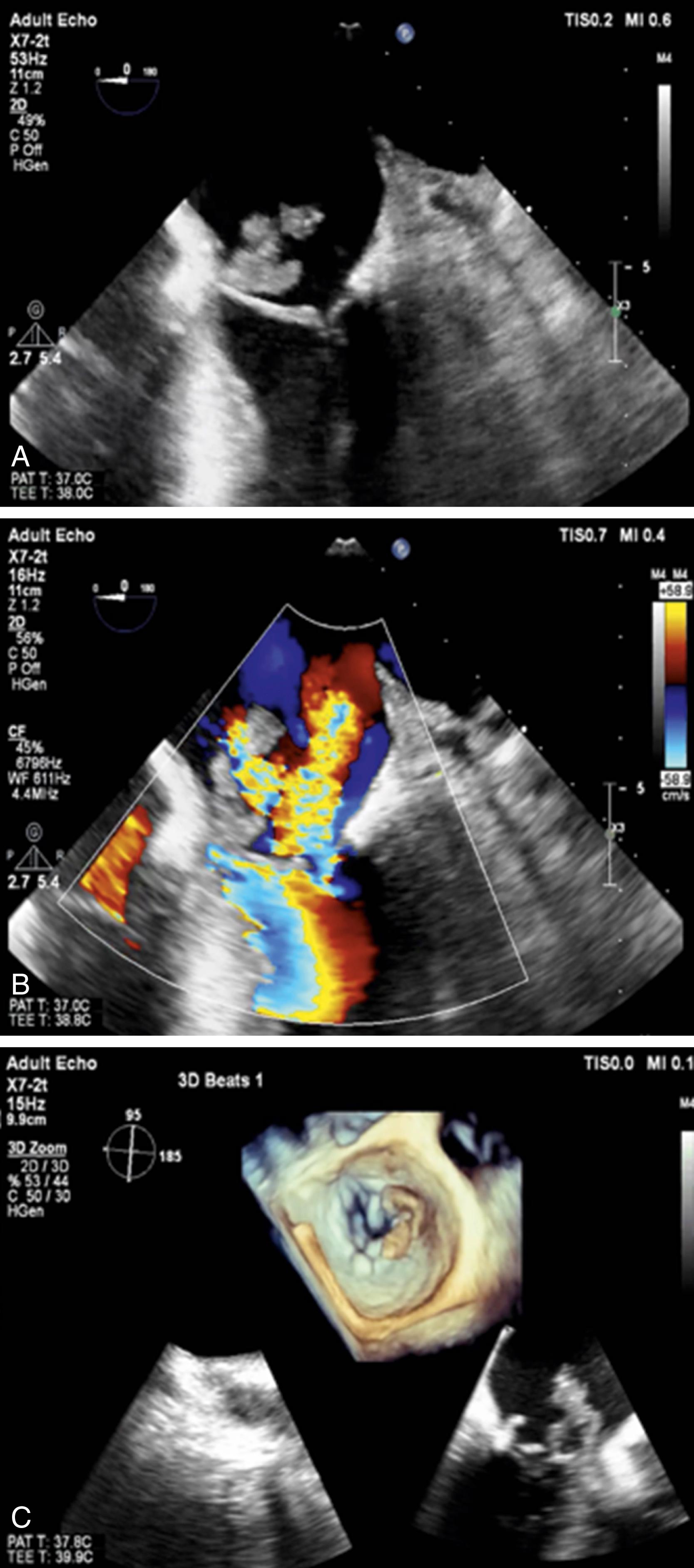 Figure 116.1, Native mitral valve infective endocarditis with large vegetation. Transesophageal echocardiography (TEE) 0-degree midesophageal view ( A ) with large, multilobed vegetation seen attached to the anterior mitral valve leaflet and severe mitral regurgitation seen on color Doppler ( B ). C, Three-dimensional TEE image of the same vegetation seen attached to the A3 segment of the anterior mitral valve leaflet.