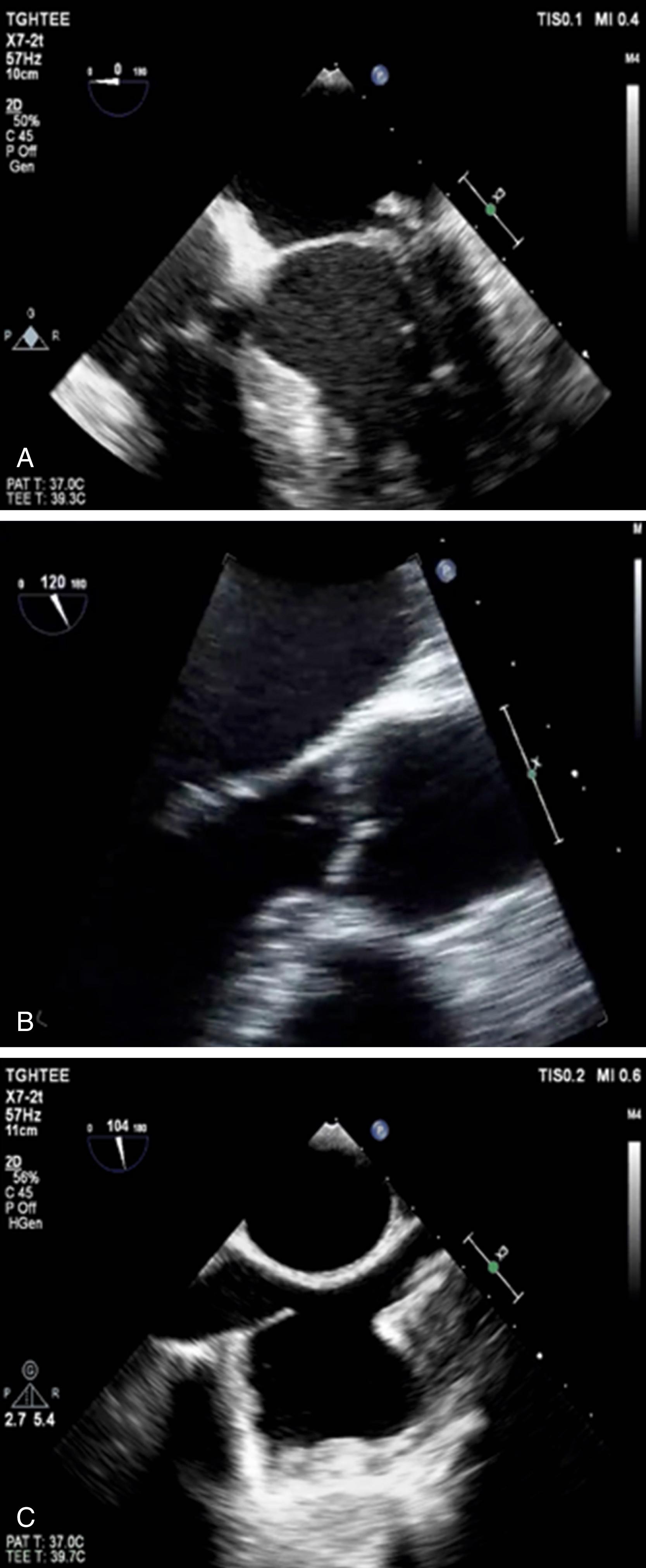 Figure 116.2, Examples of structures commonly leading to a false-positive diagnosis of infective endocarditis on echocardiography. A, Myxomatous, thickened posterior mitral valve leaflet with posterior leaflet prolapse/flail (arrow) . B, Lambl excrescence of the aortic valve (arrow) . C, Prominent Eustachian valve in the right atrium (arrow) .