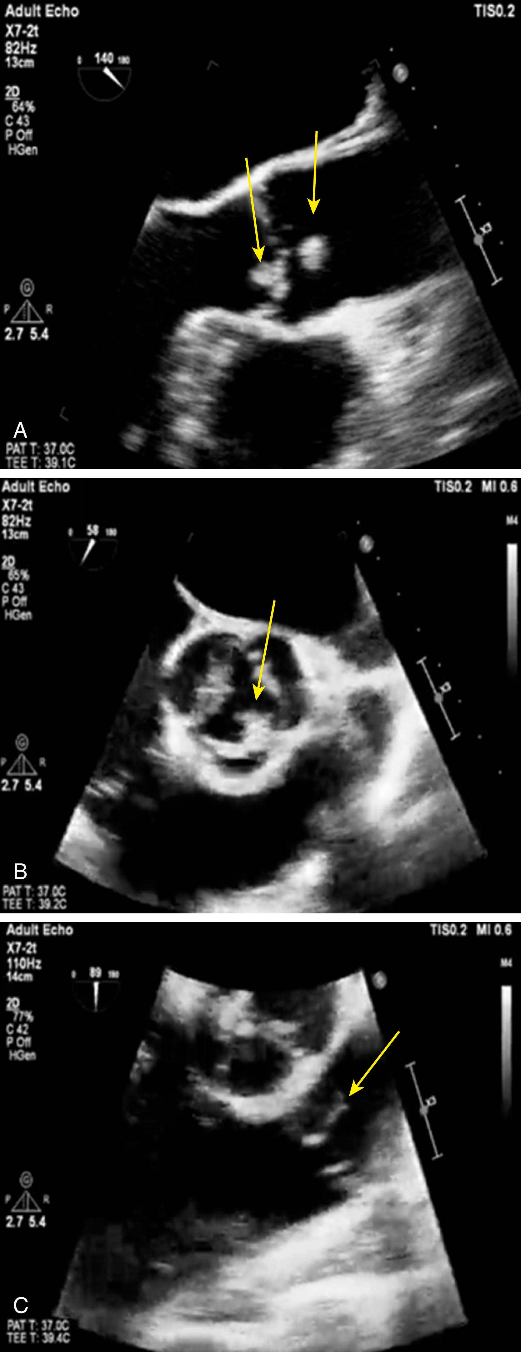 Figure 116.3, Marantic (noninfective) endocarditis involving both the aortic valve and pulmonic valve with multiple small vegetations seen without associated valvular destruction or perivalvular abscess. A, Transesophageal echocardiography (TEE) 120-degree (long-axis) view of the aortic valve with several small vegetations seen (arrows) . B, TEE 60-degree (short-axis) view of the aortic valve with the same vegetations seen. C, TEE 60-degree view of the pulmonic valve with linear echodensity seen in the same patient.
