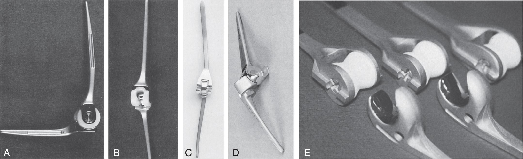 FIG 90.2, The Pritchard II (A) was an early and widely used semiconstrained elbow replacement. The triaxial implant (B) began as a snap-fit design to provide joint stability, as does the English Stanmore prosthesis (C). The GSB III (D) was a popular semiconstrained device formerly used in Europe. The Norway elbow designed by Risung (E) is a type of snap-fit design but with a spool-type snap-fit trochlear design.