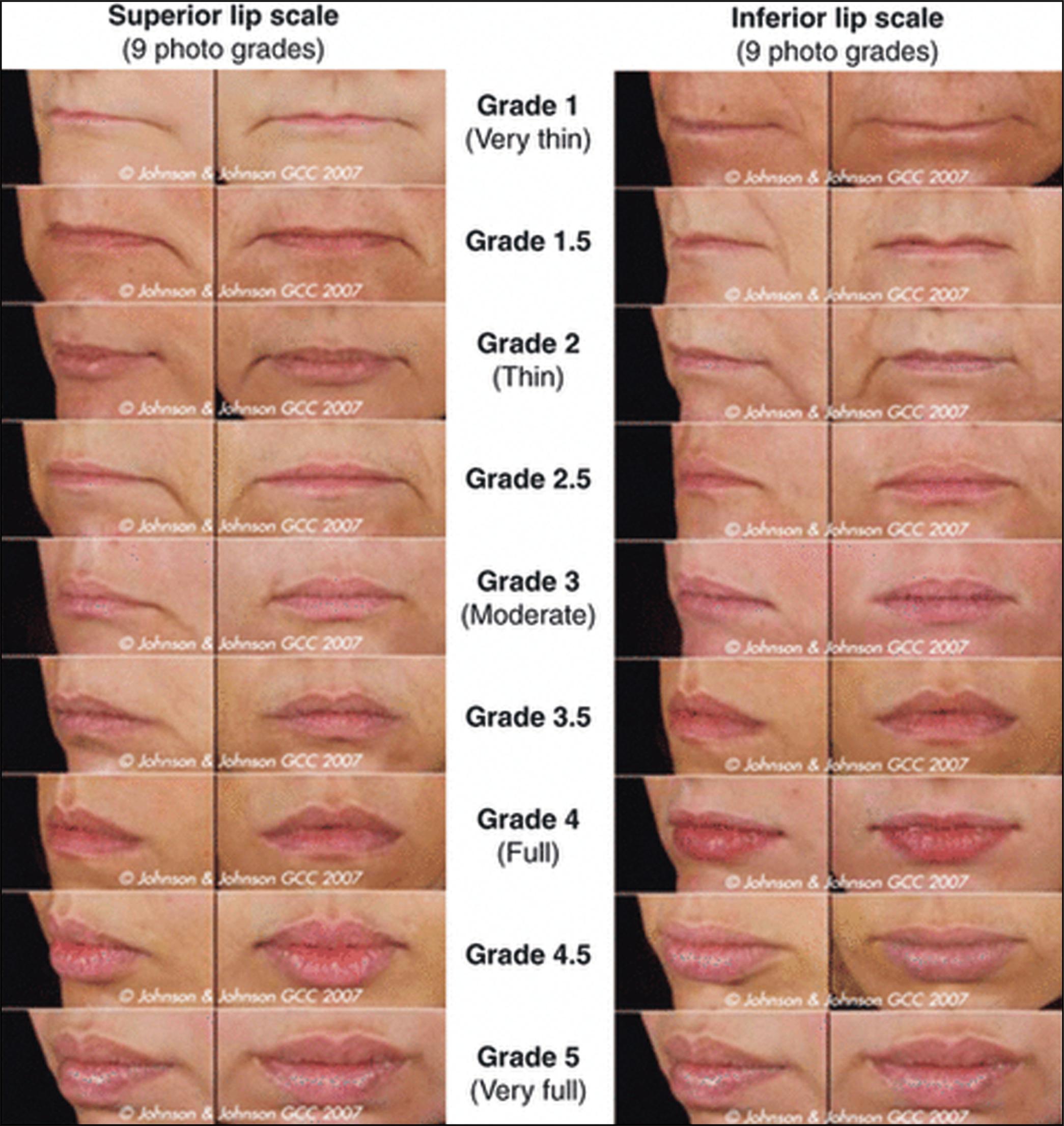 Fig. 25.1, Validated lip fullness grading scale.