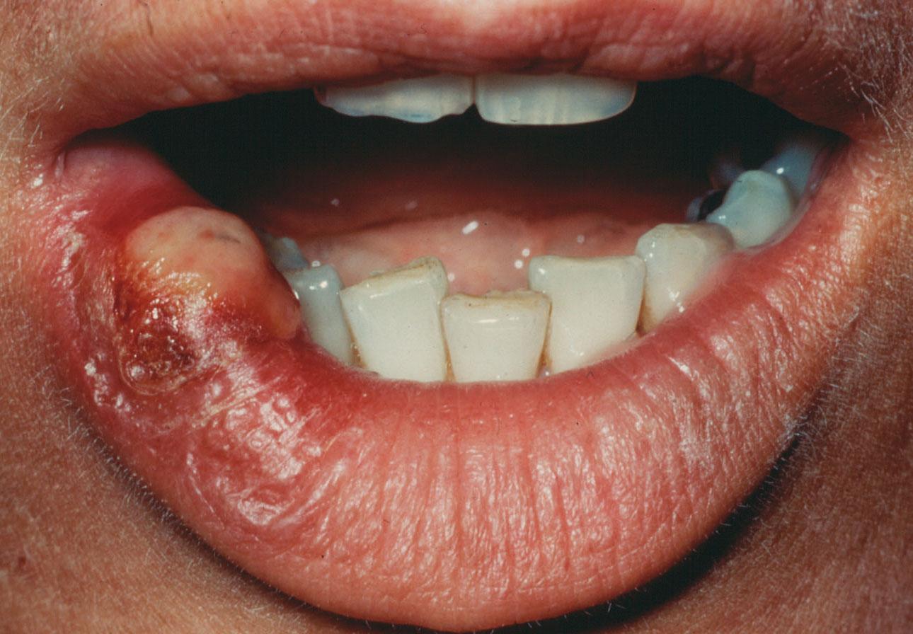 Figure 43, A squamous cell carcinoma on the lower lip .