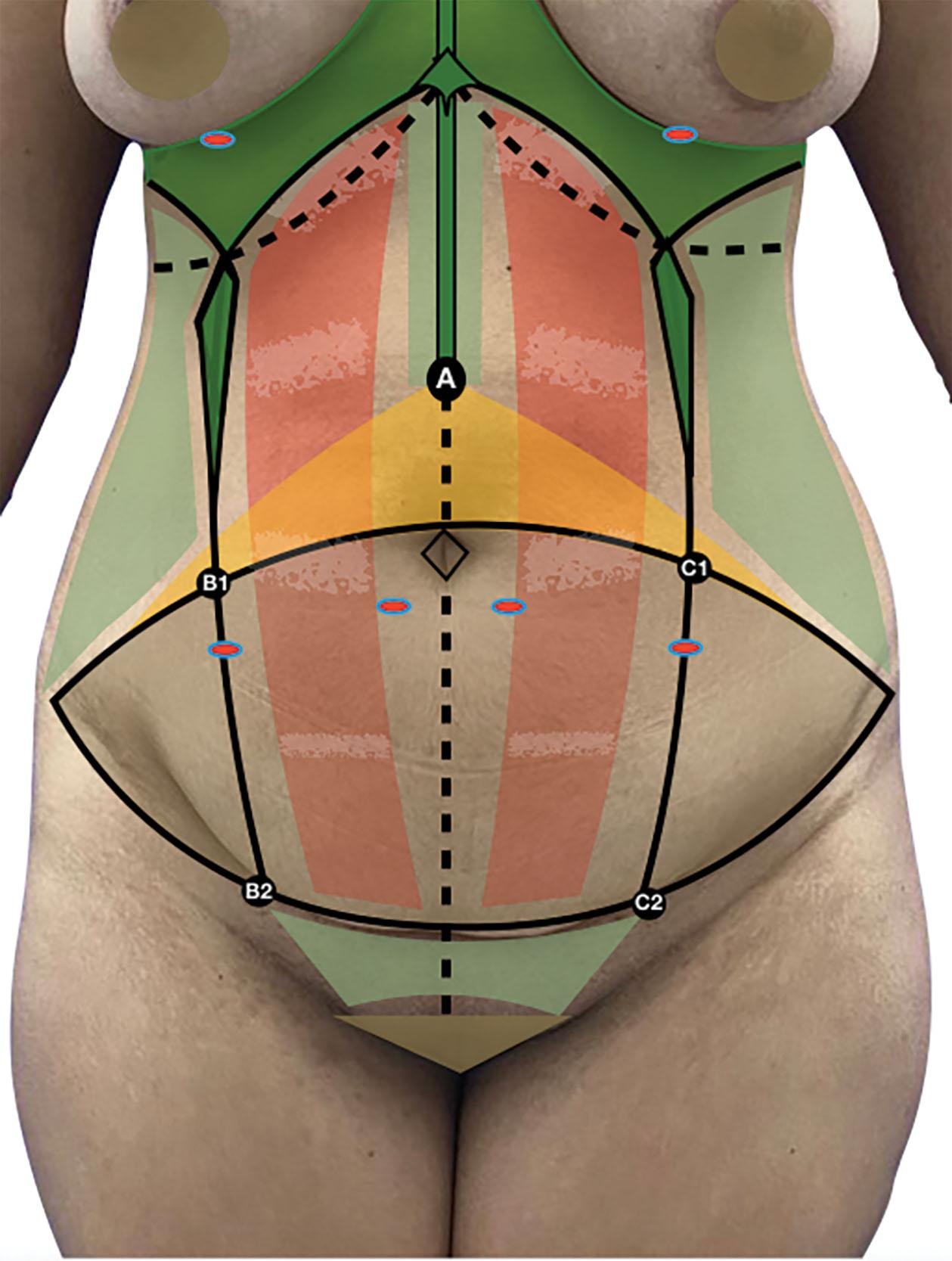 Figure 28.1, Zone 1 – light green: liposuction traditional; zone 2 – dark green: definition area negative effect (more intense liposuction, surface superficial and profound); Zone 3 – yellow: liposuction soft traditional; zone 4 – red: little or no liposuction; zone 5 – black point: new navel area (point A).