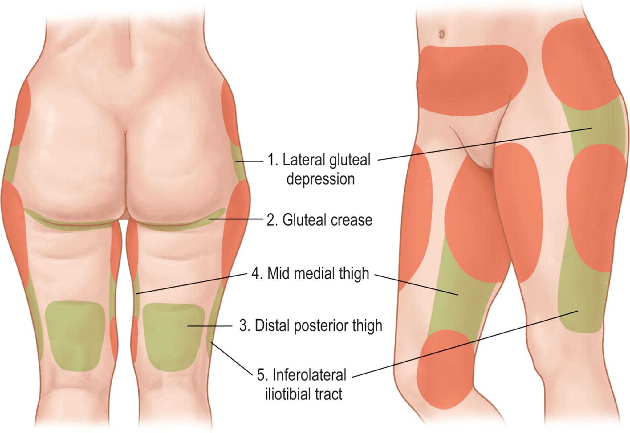 Figure 25.2.2, The zones of adherence are areas where the fibrous support structures of the subcutaneous fat and skin are adherent to the underlying deep fascia. These attachments create adherence and depressions contributing shape of the body's surface.