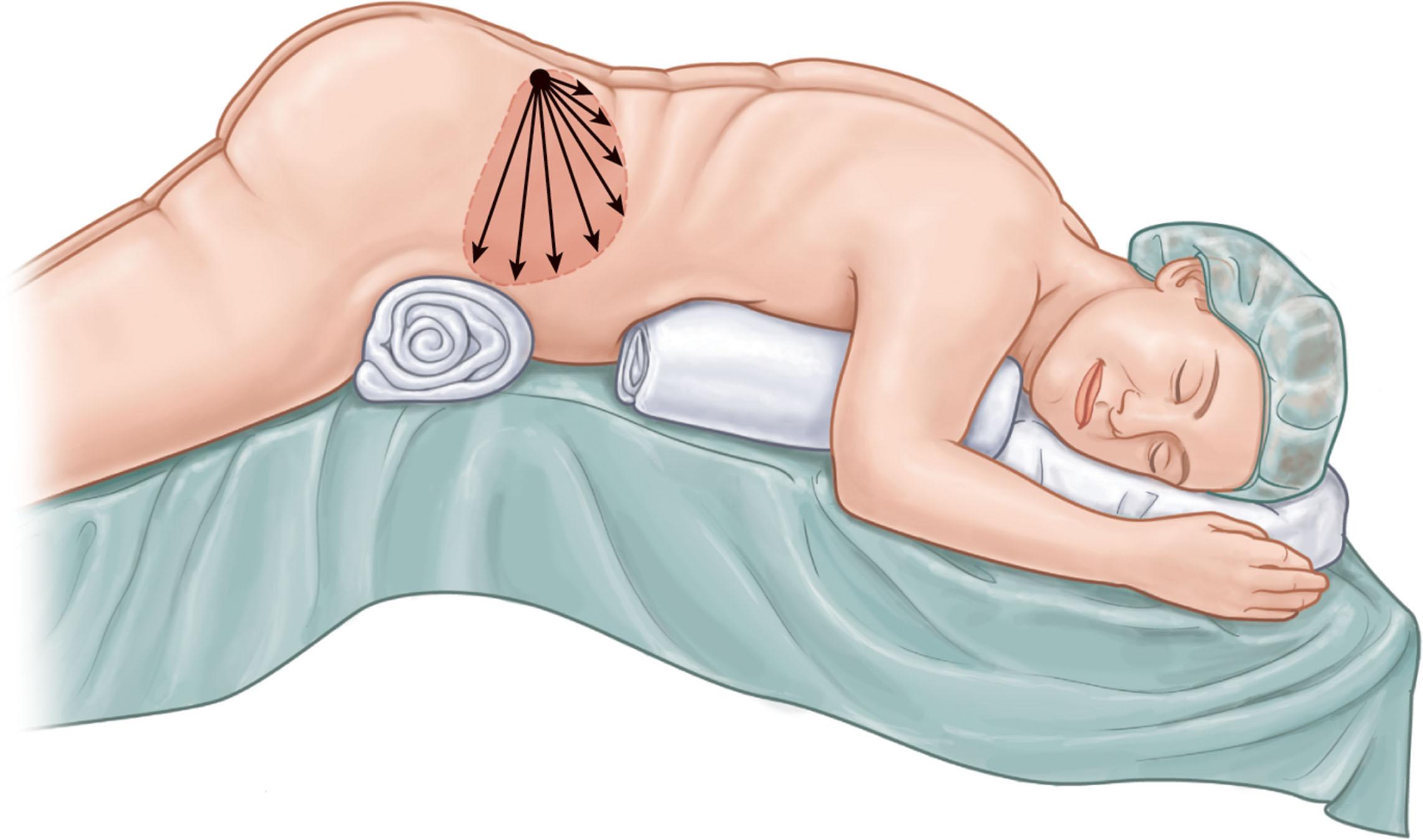 Figure 25.2.9, The patient in the prone position. A large proportion of a liposuction procedure can be performed in this position. Appropriate padding and arm position is important to avoid intraoperative complications.