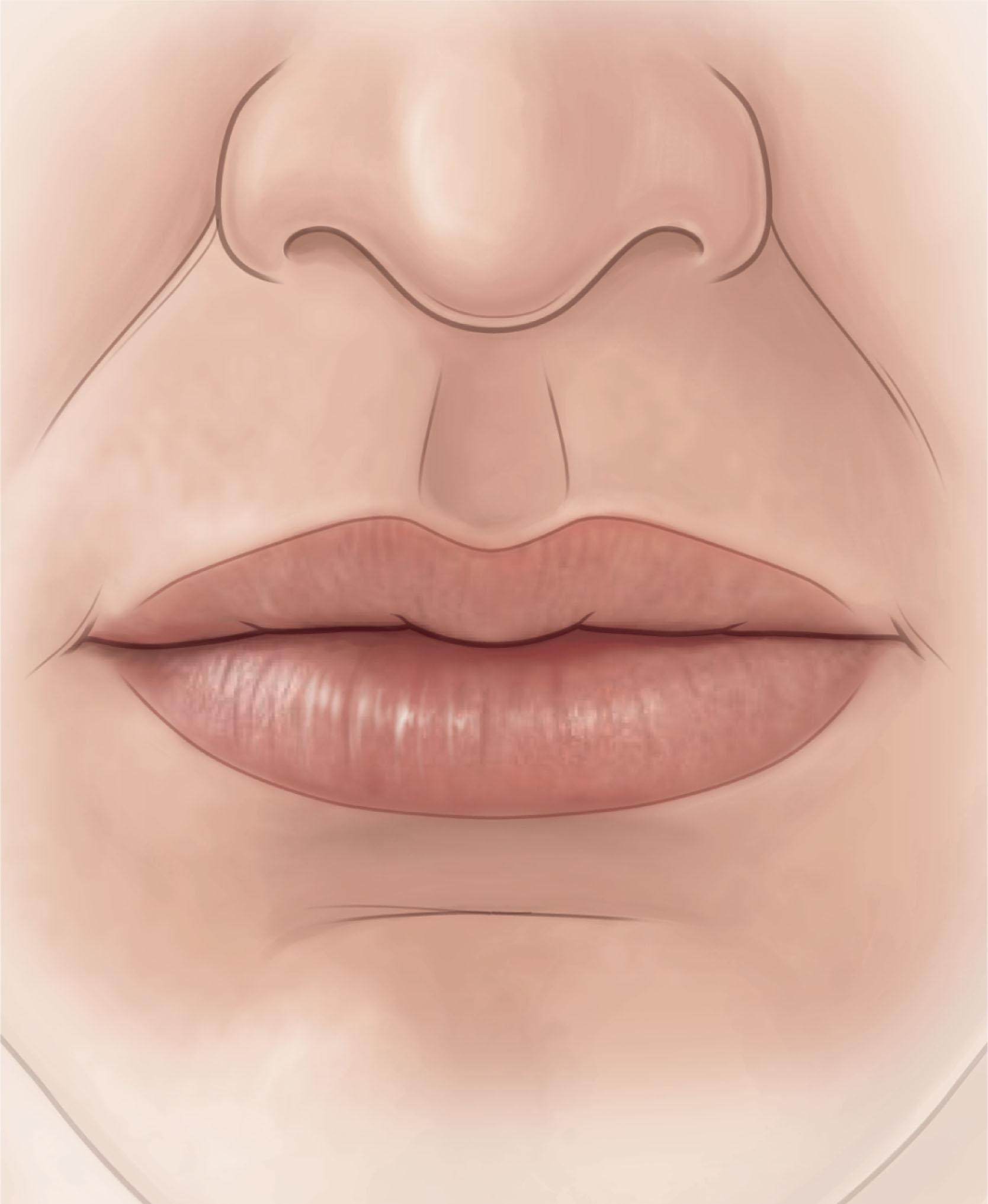 Figure 11.1, The aesthetic landmarks of the lips.