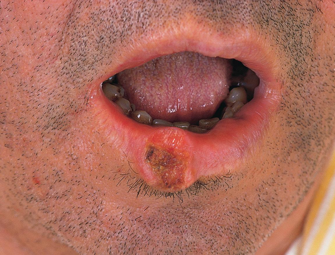 Figure 7.4, Early stage (T1) squamous cell carcinoma of the lower lip.