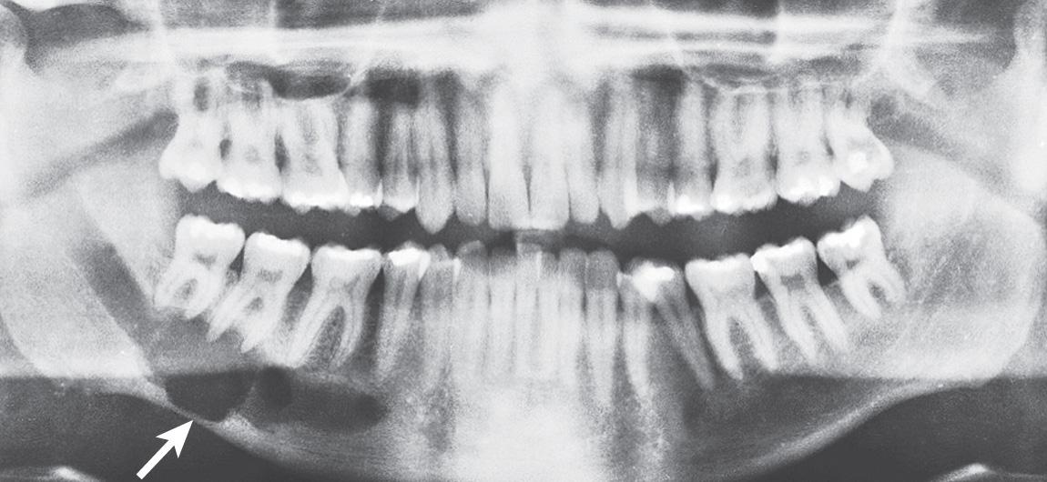 Figure 7.14, A panoramic radiograph of the mandible of the same patient in Fig. 7.13 shows invasion of the inferior alveolar nerve in the mandibular canal ( arrow ).