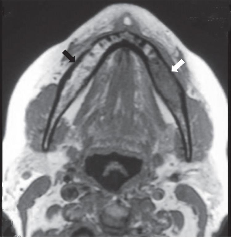 Figure 7.16, Magnetic resonance imaging showing bone marrow invasion by tumor. Black arrow, normal fat in bone marrow; white arrow, tumor in bone marrow.