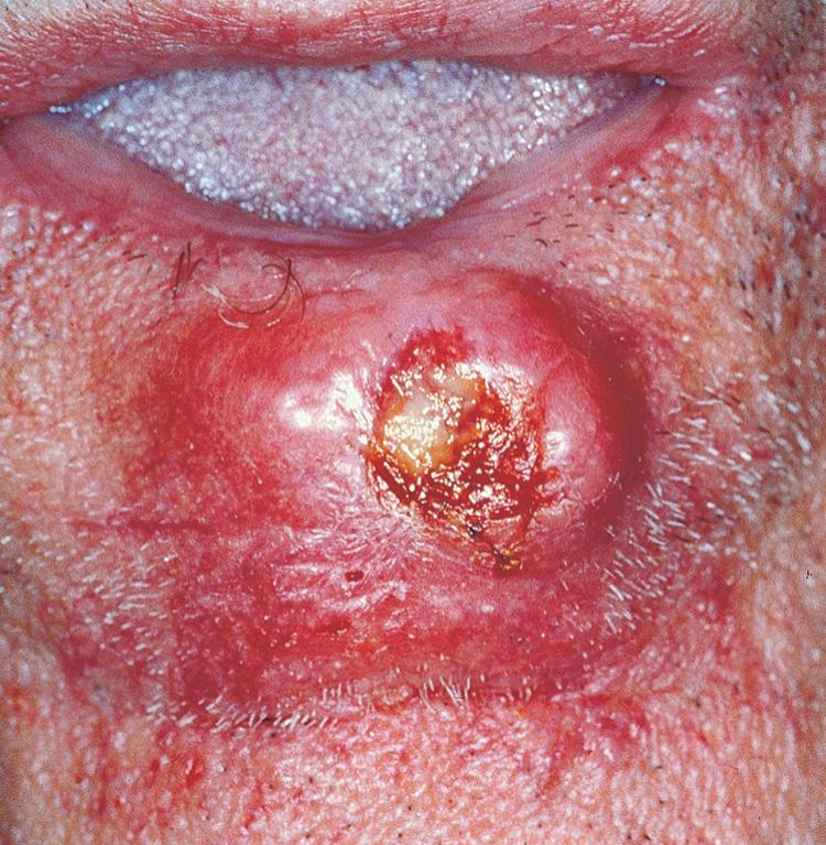 Figure 7.17, A nodular squamous cell carcinoma of the lower lip with invasion of the skin.