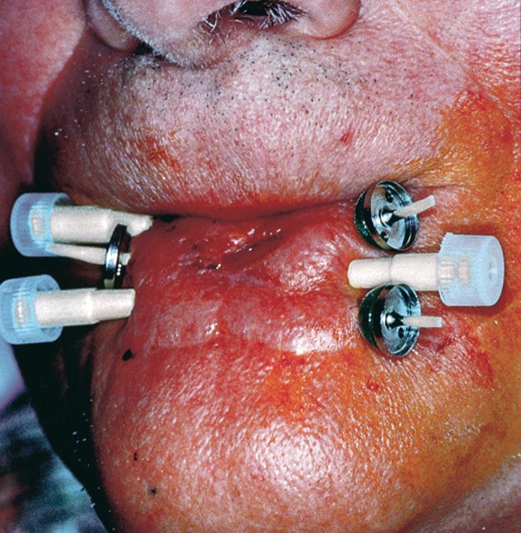 Figure 7.18, Treatment with iridium-192 after-loading interstitial implants.