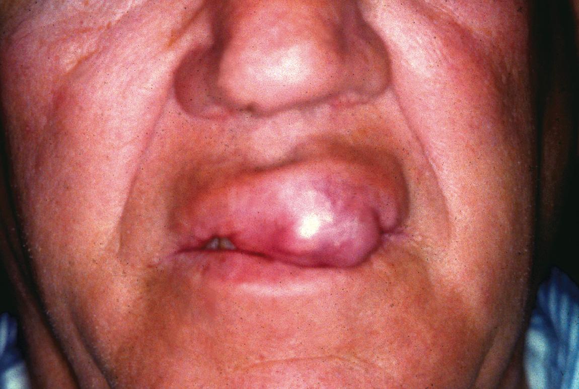 Figure 7.5, A minor salivary gland adenocarcinoma of the upper lip.