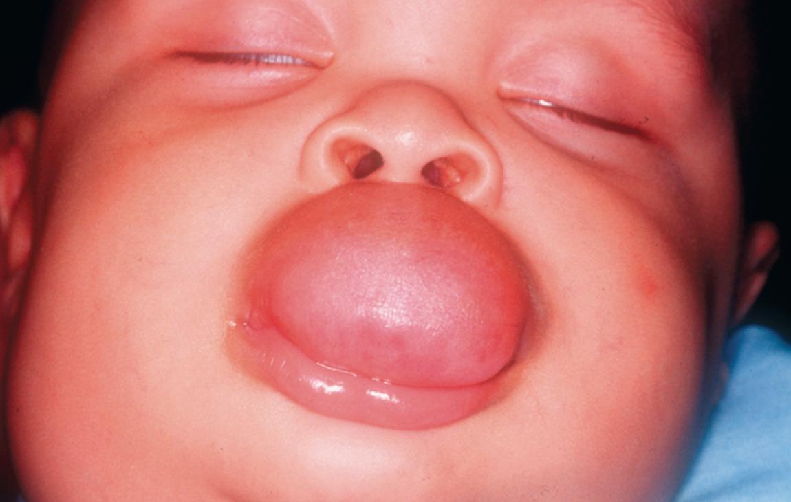 Figure 7.6, A lymphangioma of the upper lip.