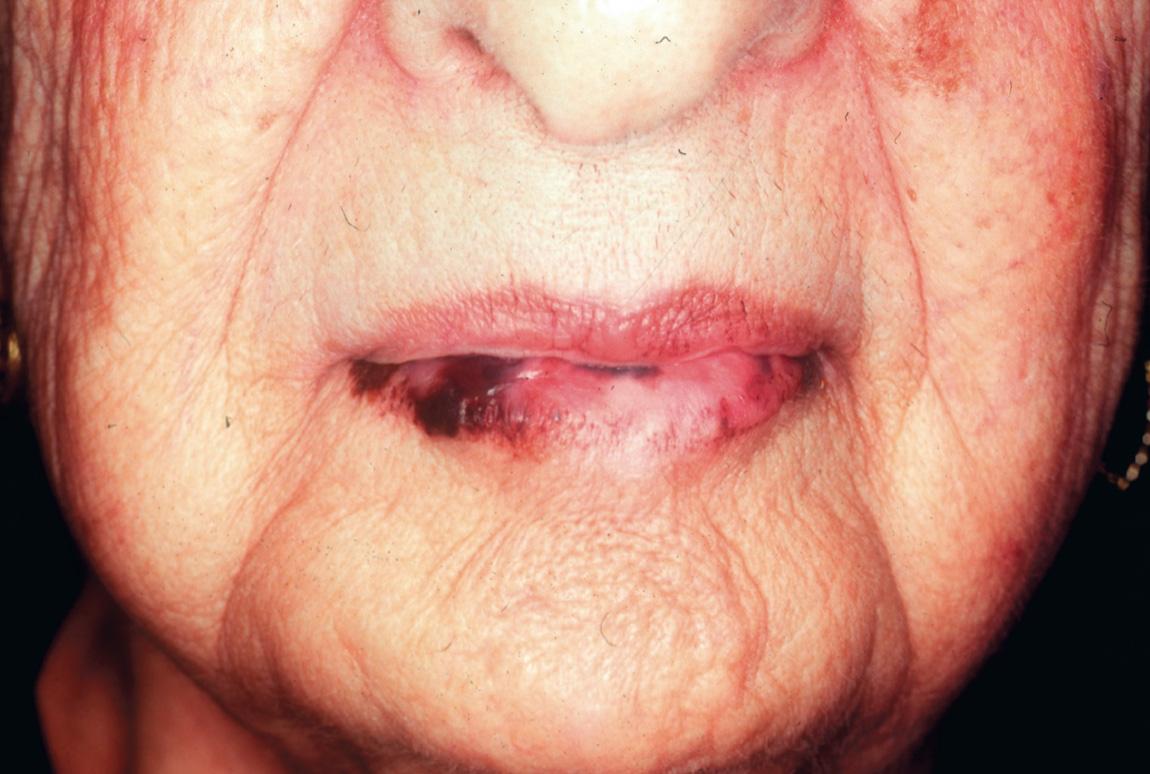 Figure 7.7, A malignant melanoma of the lower lip.