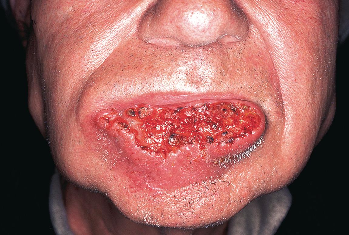 Figure 7.8, An advanced carcinoma of the lower lip with deep infiltration of soft tissues and skin.