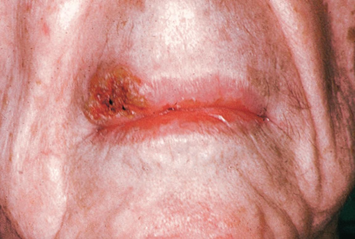 Figure 7.9, A squamous cell carcinoma of the upper lip adjacent to the commissure.