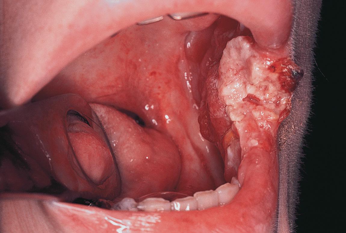 Figure 7.10, An exophytic, cauliflower-like carcinoma of the oral commissure.