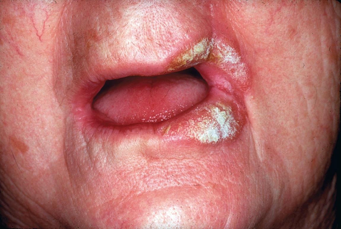 Figure 7.11, A keratinizing squamous cell carcinoma of the oral commissure with extension to the upper and lower lips.