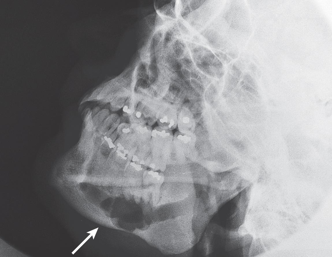 Figure 7.13, Invasion of the mandibular canal ( arrow ) seen on an oblique plain radiograph of the mandible.