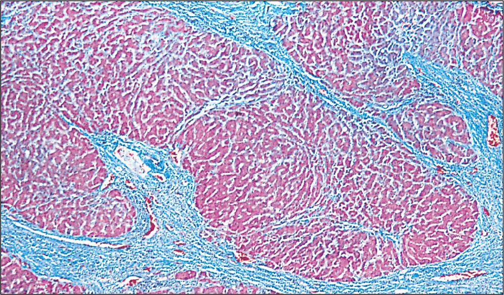 Fig. 12.9, Cirrhosis (Masson Trichrome Stain).