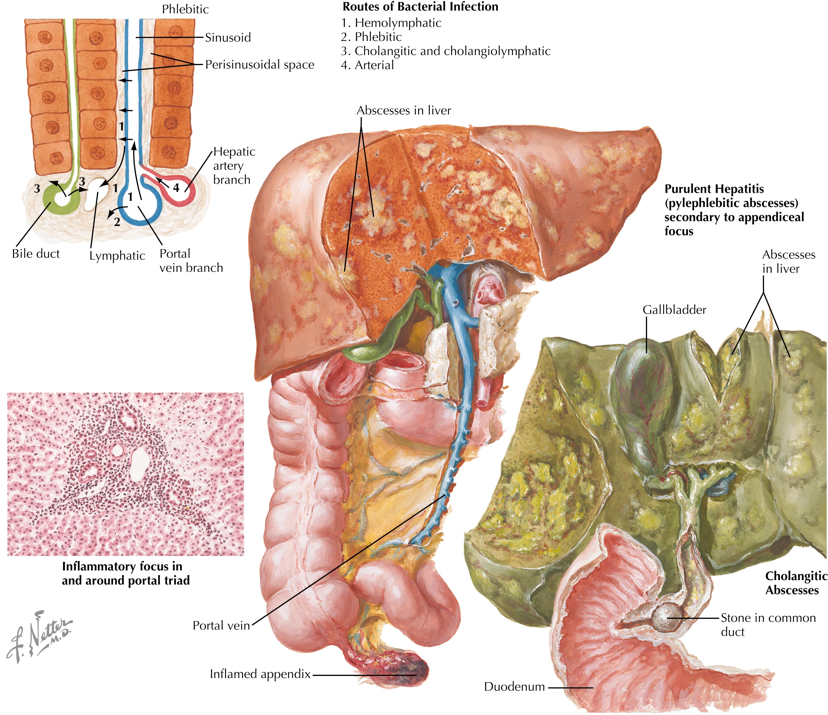 Fig. 47.1, Etiology of pyogenic liver abscess.