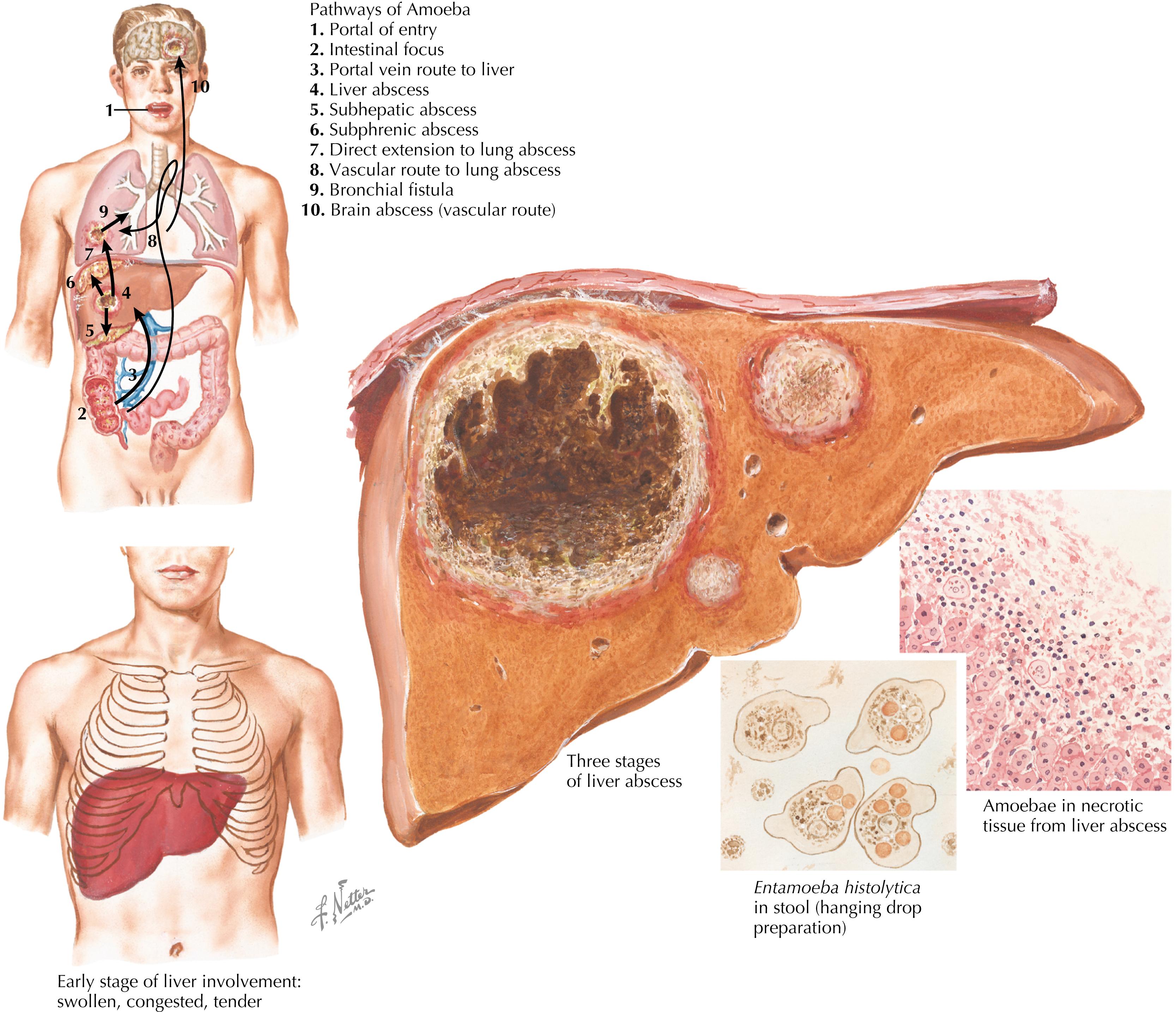 Fig. 47.2, Pathogenesis of amebic liver abscess.