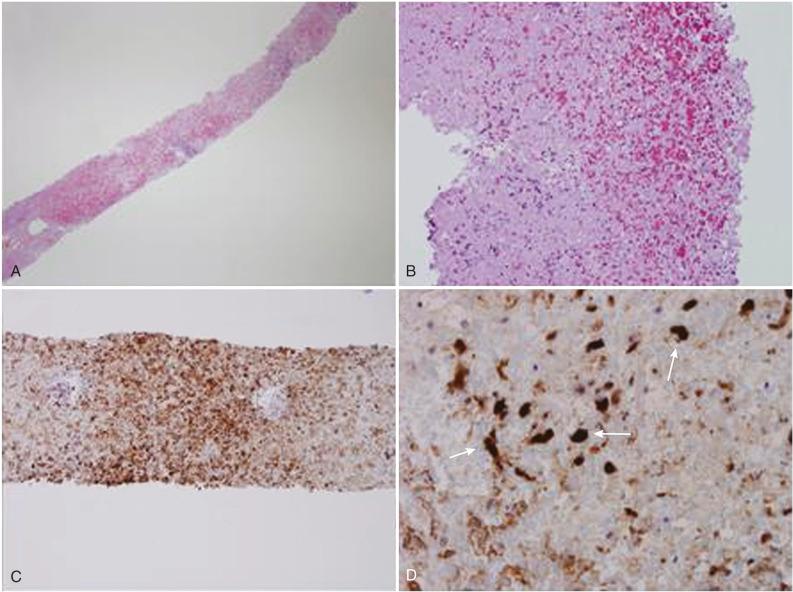 Fig. 38-3, Herpes simplex virus (HSV) hepatitis. A, Low-power micrograph (hematoxylin and eosin [H&E] stain, ×40) of the needle liver biopsy specimen showing a disruption of the overall architecture with patches of inflammatory cells. B, Higher magnification (H&E stain, ×200) reveals morphologic evidence of severe necrosis and hemorrhage. C, Immunohistochemistry for detection of HSV (×200) demonstrates extensive positive staining of necrotic hepatocytes, diffusely distributed throughout the tissue. D, Immunohistochemistry for detection of HSV (×400) emphasizes high-power magnification of the positive cells with characteristic intranuclear inclusions ( arrows ) seen with HSV.