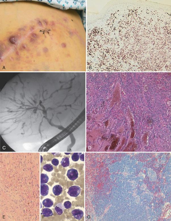 Fig. 38-4, Human herpesvirus 8 (HHV 8)-associated manifestations. A, Cutaneous Kaposi sarcoma developing in a surgical scar 4 weeks after liver transplantation. B, Detection of HHV 8 latency-associated nuclear antigen 1 in a skin section from the patient in A . C, Endoscopic retrograde cholangiopancreatography demonstrates compressed and partially blocked biliary ducts as a result of multifocal hepatic tumor infiltration (same patient as in A ). D, Liver histology illustrating typical Kaposi sarcoma with abundant spindle cells and dilated vascular spaces (same patient as in A ). E, High-power field of hepatic Kaposi sarcoma. F, Multicentric Castleman disease in a perihepatic lymph node. Histology shows many atypical follicle-like structures and abnormal vessels. G, Plasma cell–like lymphoma cells in a human immunodeficiency virus–infected patient with HHV 8-associated body cavity lymphoma.