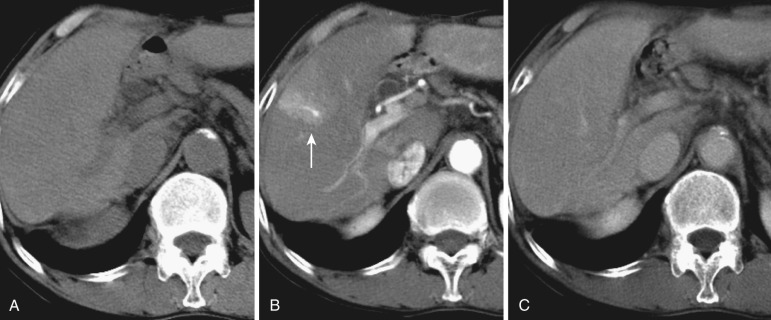 FIG 44-1, Arterioportal shunt. On dynamic CT scan ( B ) a wedge-shaped early enhancement is seen in the arterial phase, with visualization of the portal venule in the center of the lesion (arrow). However, there are no visible abnormal findings on precontrast ( A ) and equilibrium-phase ( C ) CT images.